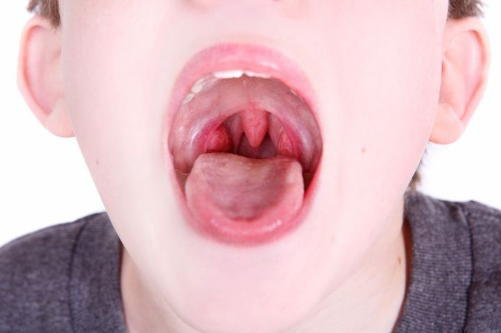 Important Warning Signs of Strep Throat