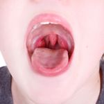Important Warning Signs of Strep Throat